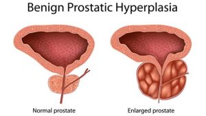 Benign prostatic hyperplasia