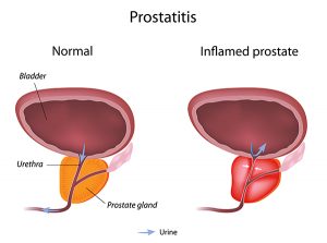 Prostatitis - Erectile Dysfunction