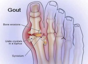 gout gout symptoms