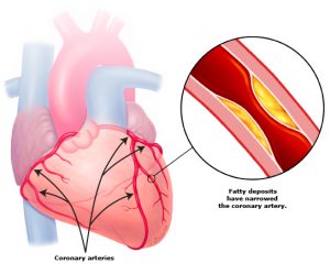 Coronary Artery Disease (Large Blood Vessels) Increased risk of a heart attack.