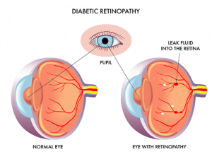 glucose control - Diabetic retinopathy